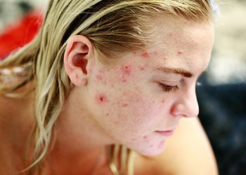 struggle, acne, self love