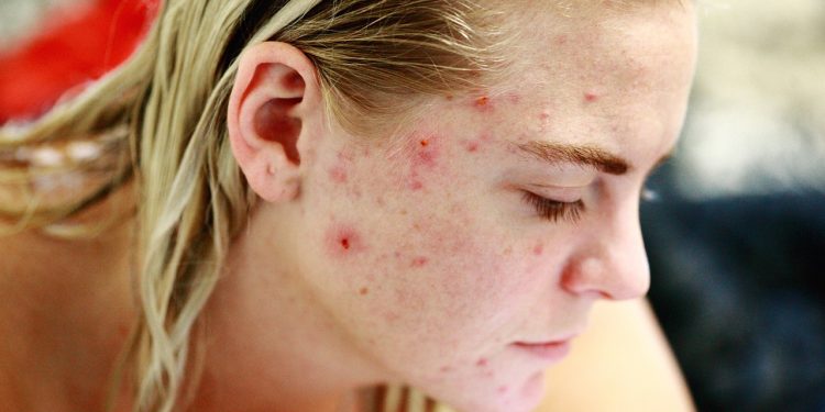 struggle, acne, self love